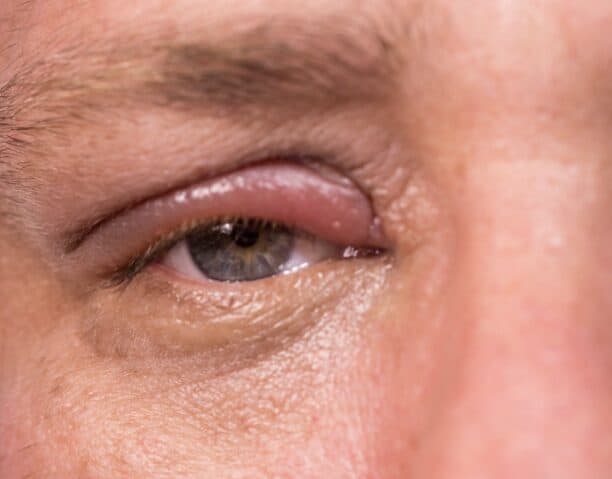 A close up of a man's eye with a stye.
