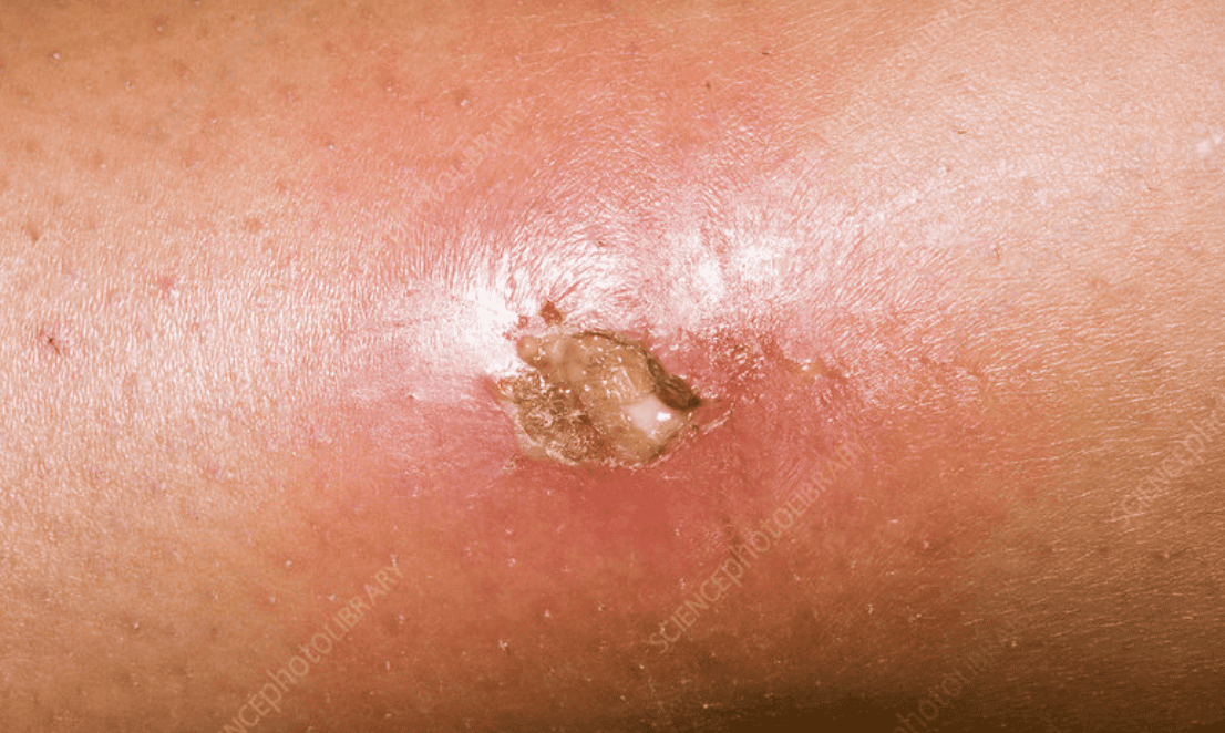 Close-up image of skin with an infected wound, showing pus and redness.