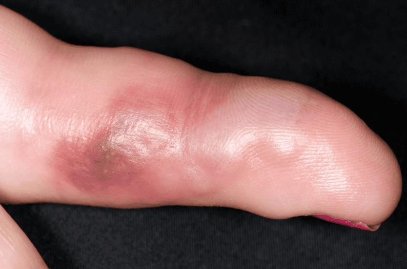 Close-up of a swollen toe with red inflammation, possibly indicative of an infection or injury, against a black background.