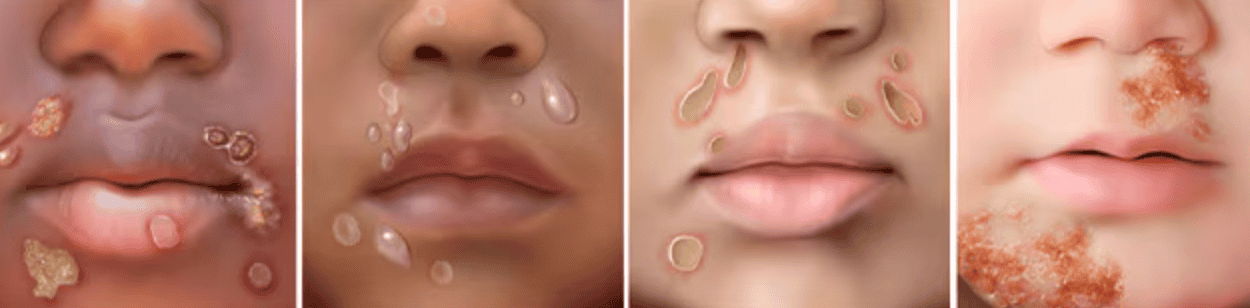 Four close-up images of different lips with various skin conditions, including impetigo, moisture droplets, dryness, and flaky patches.