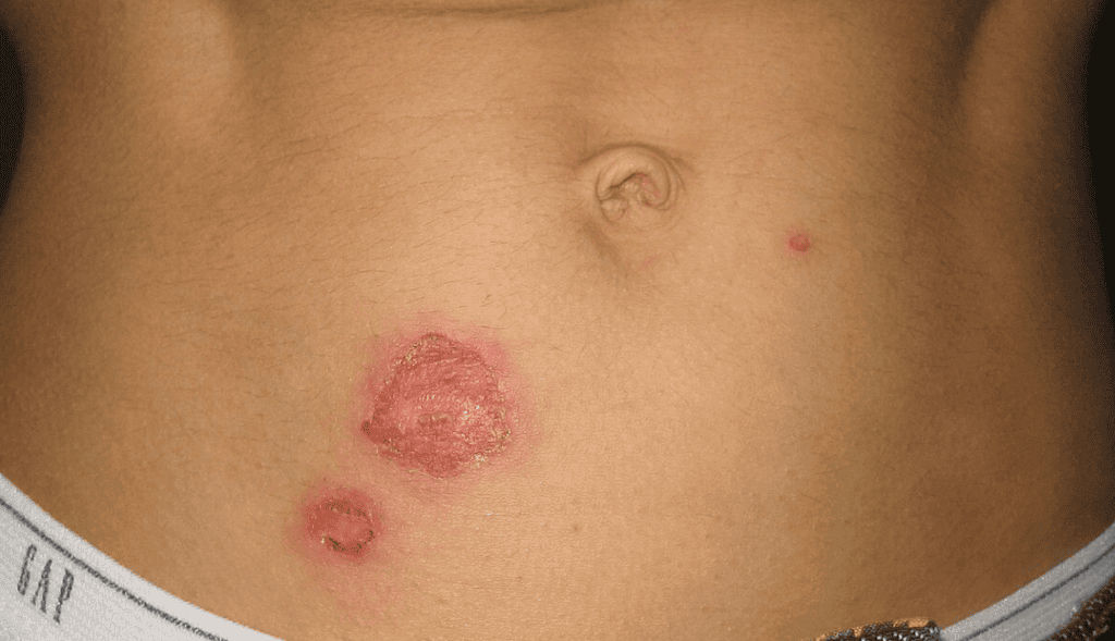 Close-up of a person's abdomen showing a large, raw wound next to the navel, with smaller red marks nearby indicative of a bacterial infection.