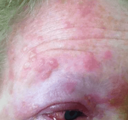 Close-up of a person's forehead showing red skin with raised bumps, reminiscent of the texture of asphalt shingles, indicative of a skin condition or allergic reaction.