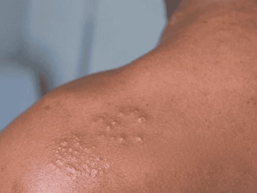 Close-up of a person's neck showing a patch of raised skin lesions resembling shingles.