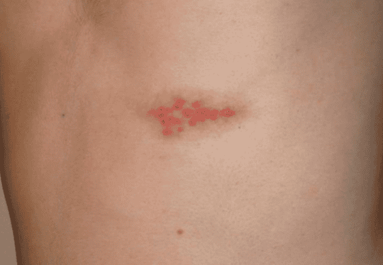 Close-up of a skin rash with red spots resembling shingles on human skin.