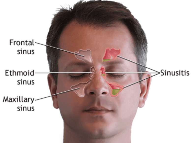 Headshot of a man with eyes closed, overlaid with an auto draft diagram showing different sinuses and areas affected by sinusitis.