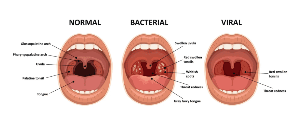 Diagram showing three types of throat conditions: normal, bacterial infection with white spots and redness, and viral infection with swollen tonsils and red throat.
